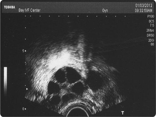 ultrasound of ovarian follicles