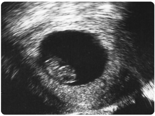 early pregnancy ultrasound